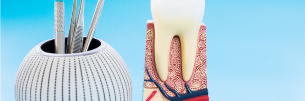 Tooth Fracture After Root Canal Treatment
